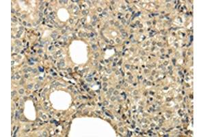 The image on the left is immunohistochemistry of paraffin-embedded Human thyroid cancer tissue using ABIN7128055(UBE2B Antibody) at dilution 1/30, on the right is treated with fusion protein. (UBE2B 抗体)