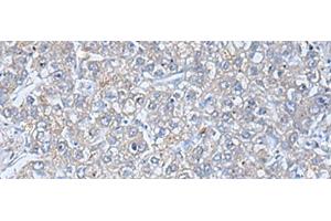 Immunohistochemistry of paraffin-embedded Human liver cancer tissue using TREM1 Polyclonal Antibody at dilution of 1:50(x200) (TREM1 抗体)