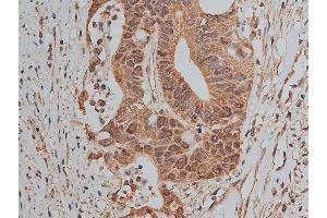 ABIN6268858 at 1/50 staining human colon cancer tissue sections by IHC-P. (MCL-1 抗体  (Internal Region))