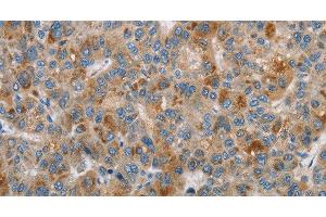 Immunohistochemistry of paraffin-embedded Human liver cancer using DBH Polyclonal Antibody at dilution of 1:70 (DBH 抗体)