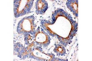 Anti-IRS1 antibody, (ABIN3043251), IHC(P)IHC(P): Human Intestinal Cancer Tissue