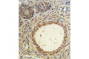 AMH Antibody IHC analysis in formalin fixed and paraffin embedded prostate carcinoma followed by peroxidase conjugation of the secondary antibody and DAB staining. (AMH 抗体  (AA 424-451))