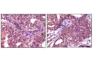 Immunohistochemical analysis of paraffin-embedded human ovary carcinoma (left) and breast carcinoma (right), showing cytoplasmic localization using EphA1 mouse mAb with DAB staining. (EPHA1 抗体)