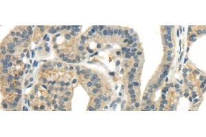 Immunohistochemistry of paraffin-embedded Human thyroid cancer tissue using CCL13 Polyclonal Antibody at dilution 1:40 (CCL13 抗体)