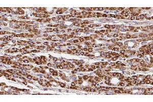 ABIN6279850 at 1/100 staining Human liver cancer tissue by IHC-P. (SLC28A1 抗体  (N-Term))