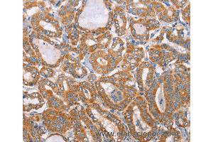 Immunohistochemistry of Human colon cancer using MTMR7 Polyclonal Antibody at dilution of 1:40 (MTMR7 抗体)