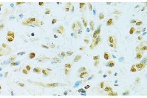 Immunohistochemistry of paraffin-embedded Human gastric cancer using RCC1 Polyclonal Antibody at dilution of 1:100 (40x lens). (RCC1 抗体)