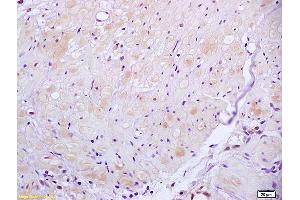 Formalin-fixed and paraffin embedded human gastric carcinoma tissue labeled with Anti ROCK2 Polyclonal Antibody, unconjugated (ABIN673359) at 1:200 followed by incubation with conjugated secondary antibody and DAB staining (ROCK2 抗体  (AA 1001-1300))
