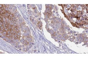 ABIN6277181 at 1/100 staining Human urothelial cancer tissue by IHC-P. (RAPGEF3 抗体  (C-Term))