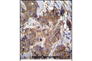 ATP6V1B1 Antibody (C-term) (ABIN656224 and ABIN2845541) immunohistochemistry analysis in formalin fixed and paraffin embedded human breast carcinoma followed by peroxidase conjugation of the secondary antibody and DAB staining. (ATP6V1B1 抗体  (C-Term))