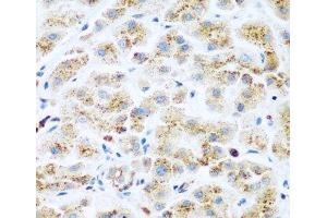 Immunohistochemistry of paraffin-embedded Human liver cancer using KIAA1456 Polyclonal Antibody at dilution of 1:200 (40x lens). (KIAA1456 抗体)