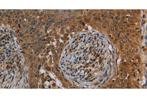 Immunohistochemistry of paraffin-embedded Human cervical cancer tissue using OSM Polyclonal Antibody at dilution 1:40 (Oncostatin M 抗体)