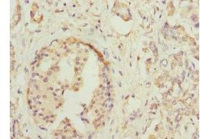 Immunohistochemistry of paraffin-embedded human pancreatic cancer using ABIN7155761 at dilution of 1:100 (HOXD1 抗体  (AA 1-240))