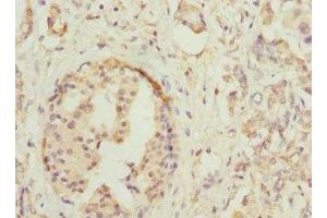 Immunohistochemistry of paraffin-embedded human pancreatic cancer using ABIN7155761 at dilution of 1:100