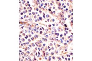 (ABIN6242397 and ABIN6578004) staining IL24 in human melanoma sections by Immunohistochemistry (IHC-P - paraformaldehyde-fixed, paraffin-embedded sections). (IL-24 抗体)