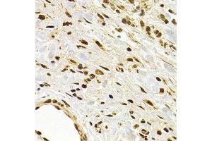 Immunohistochemistry of paraffin-embedded human stomach cancer using DNMT3A antibody at dilution of 1:200 (400x lens). (DNMT3A 抗体)