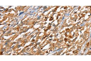 Immunohistochemistry of paraffin-embedded Human esophagus cancer using CAPG Polyclonal Antibody at dilution of 1:40 (CAPG 抗体)