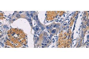 Immunohistochemistry of paraffin-embedded Human esophagus cancer tissue using FAM20C Polyclonal Antibody at dilution of 1:45(x200) (FAM20C 抗体)