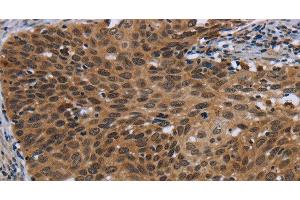 Immunohistochemistry of paraffin-embedded Human cervical cancer using CEBPD Polyclonal Antibody at dilution of 1:40 (CEBPD 抗体)