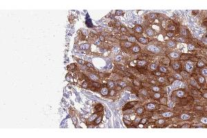 ABIN6276987 at 1/100 staining Human Head and neck cancer tissue by IHC-P. (HVEM 抗体  (C-Term))