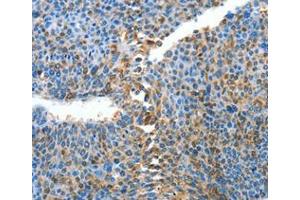 Immunohistochemical analysis of paraffin-embedded Human liver cancer tissue using at dilution 1/25. (ALPK1 抗体  (C-Term))