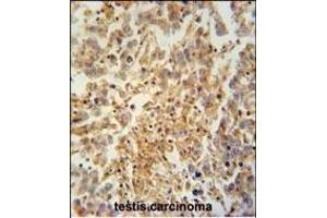 TEX9 antibody (N-term) (ABIN654569 and ABIN2844274) immunohistochemistry analysis in formalin fixed and paraffin embedded human testis carcinoma followed by peroxidase conjugation of the secondary antibody and DAB staining. (TEX9 抗体  (N-Term))