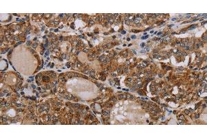 Immunohistochemistry of paraffin-embedded Human thyroid cancer tissue using MT-ND6 Polyclonal Antibody at dilution 1:40 (MT-ND6 抗体)