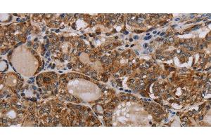 Immunohistochemistry of paraffin-embedded Human thyroid cancer tissue using MT-ND6 Polyclonal Antibody at dilution 1:40