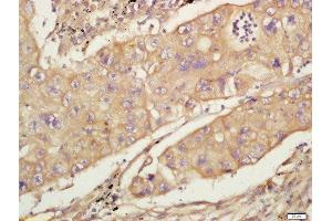 Formalin-fixed and paraffin embedded human lung carcinoma labeled with Anti-CD44 Polyclonal Antibody, Unconjugated  at 1:200 followed by conjugation to the secondary antibody and DAB staining (CD44 抗体  (AA 325-429))