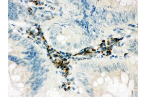 Anti-SPARCL1 antibody, IHC(P) IHC(P): Human Intestinal Cancer Tissue (SPARCL1 抗体  (C-Term))