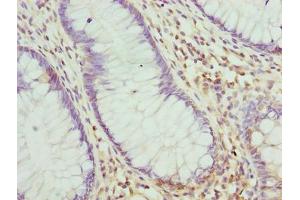 Immunohistochemistry of paraffin-embedded human colon cancer using ABIN7168234 at dilution of 1:100 (RING1 抗体  (AA 401-630))