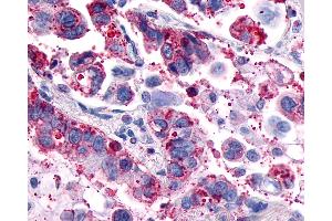 Anti-GPR4 antibody IHC of human Lung, Adenocarcinoma. (GPR4 抗体  (Cytoplasmic Domain))