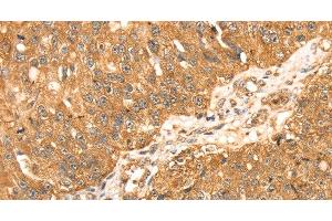 Immunohistochemistry of paraffin-embedded Human breast cancer using ERK 5 Polyclonal Antibody at dilution of 1:35 (MAPK7 抗体)