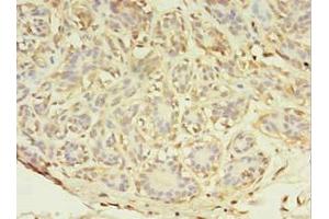 Immunohistochemistry of paraffin-embedded human breast cancer using ABIN7143952 at dilution of 1:100 (ABHD14A 抗体  (AA 56-258))