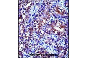 CRYA Antibody (Center) (ABIN657620 and ABIN2846616) immunohistochemistry analysis in formalin fixed and paraffin embedded human kidney carcinoma followed by peroxidase conjugation of the secondary antibody and DAB staining. (CRYAB 抗体  (AA 84-112))