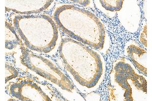 ABIN6265225 and ABIN6277101 at 1/100 staining human ovarian cancer by IHC-P. (SORD 抗体  (Internal Region))