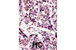 Formalin-fixed and paraffin-embedded human hepatocellular carcinoma tissue reacted with ARL1 polyclonal antibody  , which was peroxidase-conjugated to the secondary antibody, followed by DAB staining . (ARL1 抗体  (N-Term))