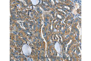 Immunohistochemistry of Human liver cancer using ADCY4 Polyclonal Antibody at dilution of 1:45 (ADCY4 抗体)