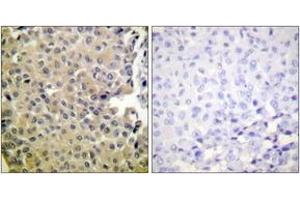 Immunohistochemistry analysis of paraffin-embedded human breast carcinoma, using PP1-alpha (Phospho-Thr320) Antibody.