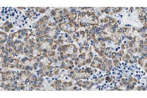 ABIN6275089 at 1/100 staining Human liver cancer tissue by IHC-P. (MYLIP 抗体  (Internal Region))