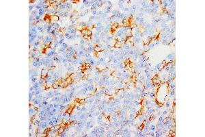 Anti-Myeloperoxidase antibody, IHC(P) IHC(P): Human Liver Cancer Tissue (Myeloperoxidase 抗体  (C-Term))