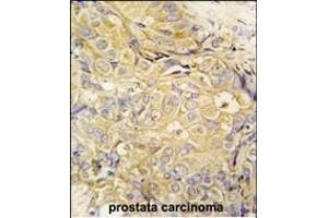Formalin-fixed and paraffin-embedded human prostata carcinoma tissue reacted with FGF10 antibody (C-term) (ABIN392510 and ABIN2842073) , which was peroxidase-conjugated to the secondary antibody, followed by DAB staining. (FGF10 抗体  (C-Term))
