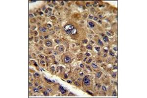 Formalin-Fixed, Paraffin-Eembedded Human hepatocarcinoma reacted with TOB1 Antibody (N-term), which was peroxidase-conjugated to the secondary antibody, followed by DAB staining. (Protein Tob1 (TOB1) (AA 61-91), (N-Term) 抗体)