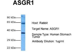 Host: Rabbit Target Name: ASGR1 Sample Tissue: Human Stomach Tumor Antibody Dilution: 1. (Asialoglycoprotein Receptor 1 抗体  (Middle Region))