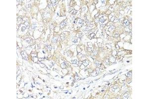 Immunohistochemistry of paraffin-embedded Human liver cancer using ATP1B1 Polyclonal Antibody at dilution of 1:100 (40x lens). (ATP1B1 抗体)