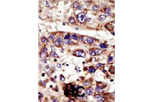 Formalin-fixed and paraffin-embedded human hepatocellular carcinoma tissue reacted with ZMPSTE24 polyclonal antibody  , which was peroxidase-conjugated to the secondary antibody, followed by DAB staining . (ZMPSTE24 抗体  (C-Term))