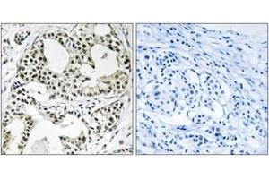 Immunohistochemistry analysis of paraffin-embedded human breast carcinoma, using YEATS2 Antibody. (YEATS2 抗体  (AA 341-390))