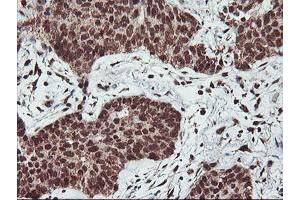 Immunohistochemical staining of paraffin-embedded Carcinoma of Human lung tissue using anti-PDE4B mouse monoclonal antibody. (PDE4B 抗体)