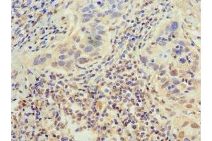 Immunohistochemistry of paraffin-embedded human bladder cancer using ABIN7155286 at dilution of 1:100 (PTGER3 抗体  (AA 2283-2414))