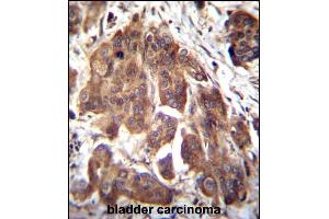 GLMN Antibody (C-term) (ABIN655986 and ABIN2845370) immunohistochemistry analysis in formalin fixed and paraffin embedded human bladder carcinoma followed by peroxidase conjugation of the secondary antibody and DAB staining. (GLMN 抗体  (C-Term))